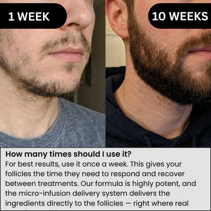 AlphaInfuse™ Beard Growth System